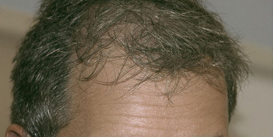 Man discussing hair loss with a doctor online.