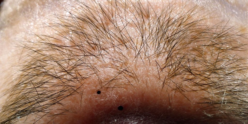 Close-up photo of a scalp with a black dot.