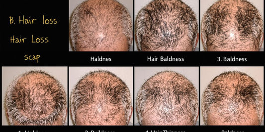 Close-up of diverse hair loss patterns on a scalp.