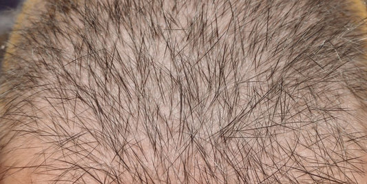 Man observing hair regrowth on his head.