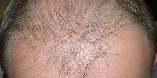 Thinning hair on a person's scalp.