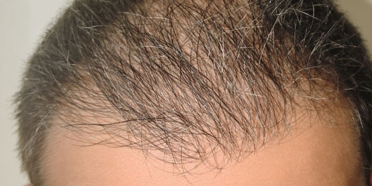 Man experiencing hair thinning near temples