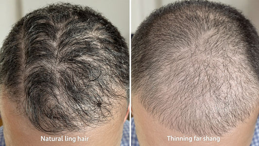 Hair whorl versus balding scalp comparison