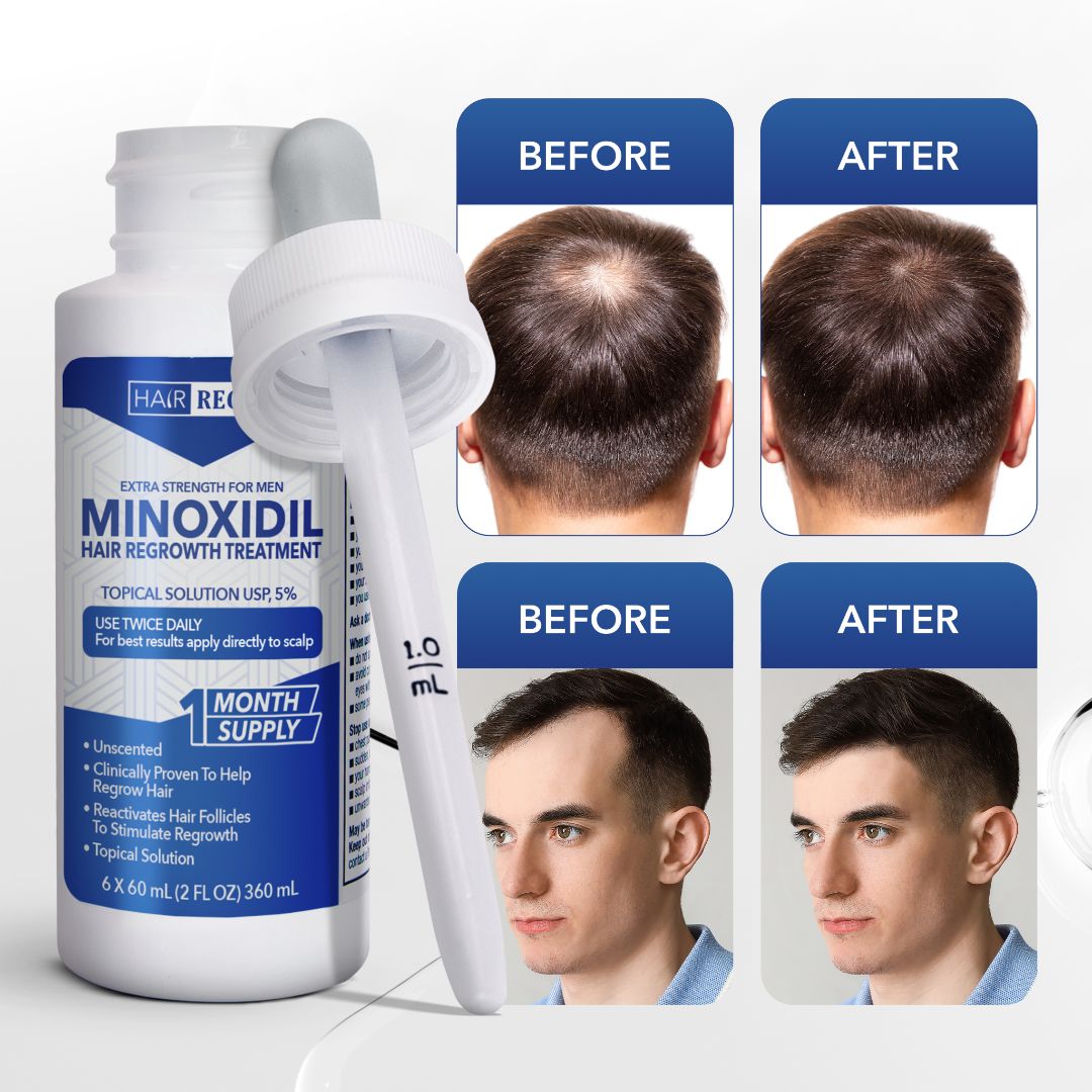 Hair-Regen: 5% Minoxidil Hair Regrowth Treatment for Men