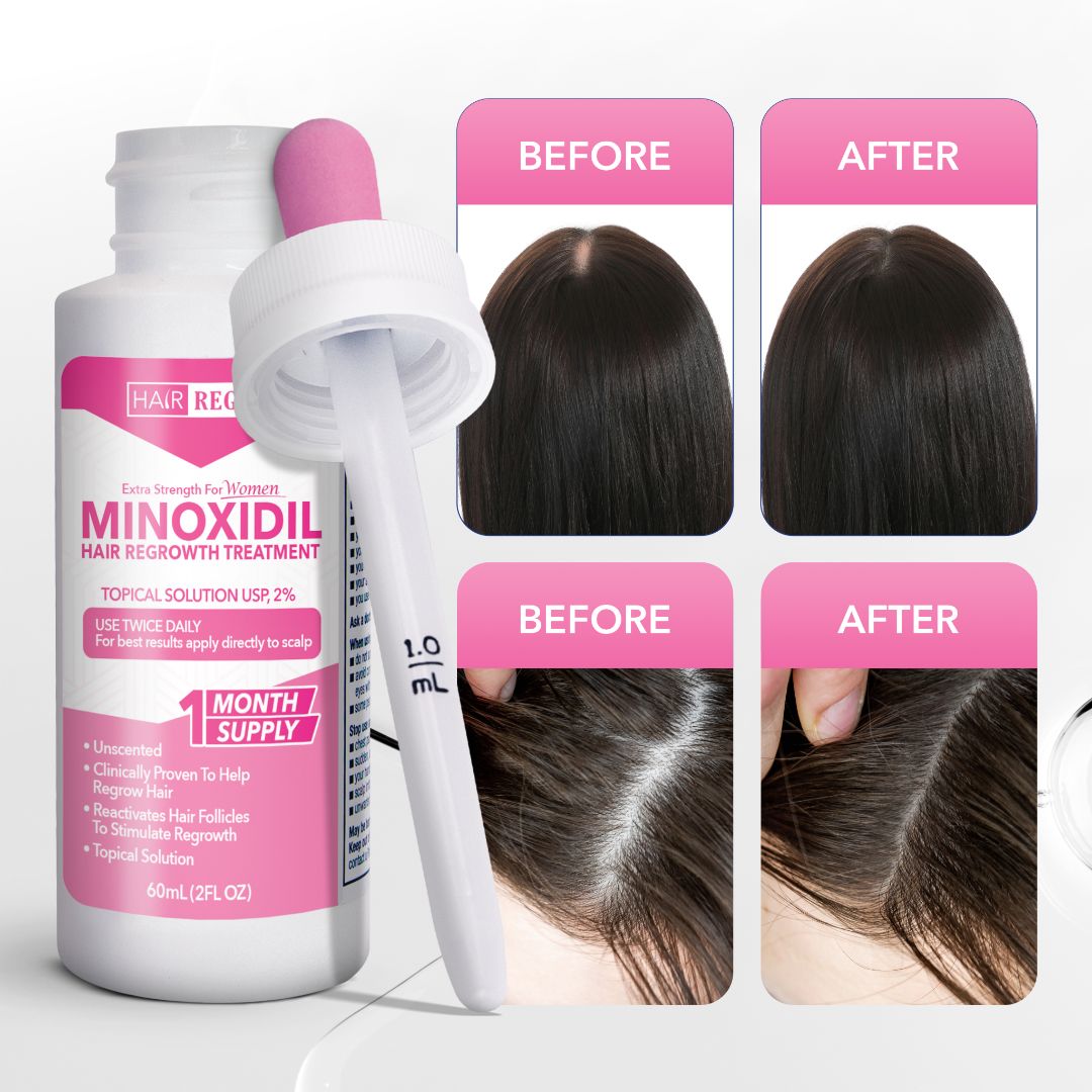 Hair-Regen: 5% Minoxidil Hair Regrowth Treatment for Women