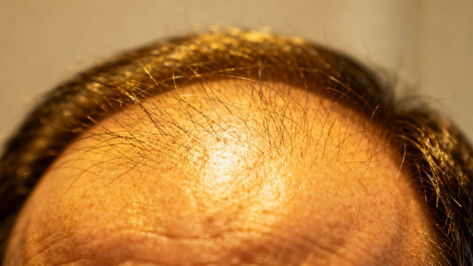 Person's scalp with thinning hair, close-up view.