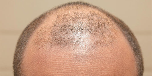 A man's scalp with new hair growth