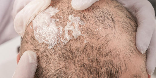 Man with thicker hair after treatment.