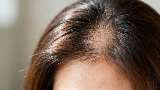 Woman's head showing hair thinning