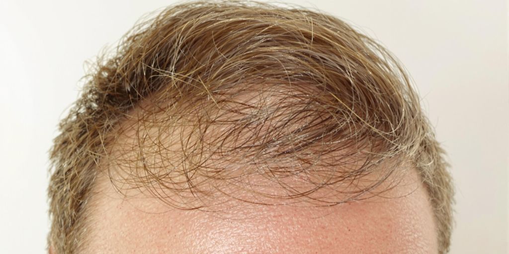 Man's hair with cowlick, some hair loss.