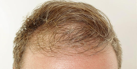 Man's hair with cowlick, some hair loss.