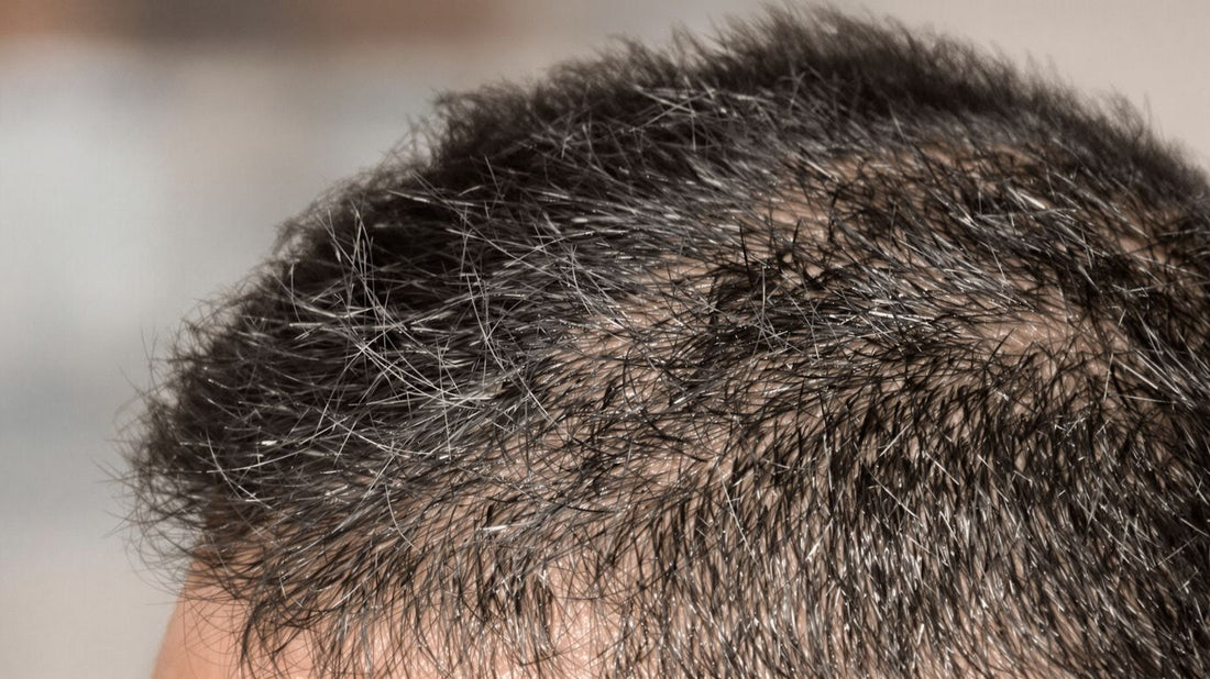 Scalp with healthy hair regrowth after treatment.