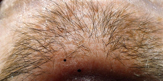 Close-up photo of a scalp with a black dot.