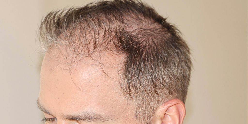 Man with thinning hair on the sides of his head.