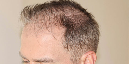 Man with thinning hair on the sides of his head.