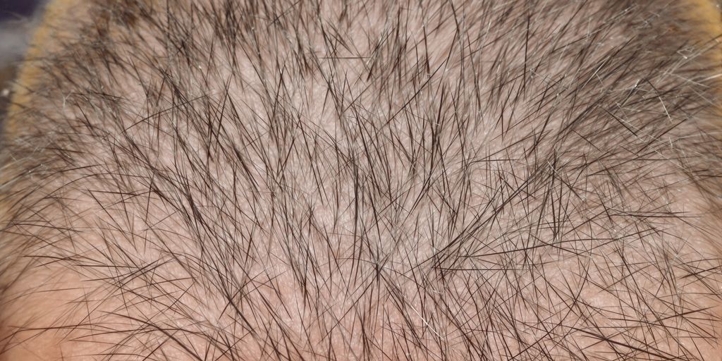 Man observing hair regrowth on his head.