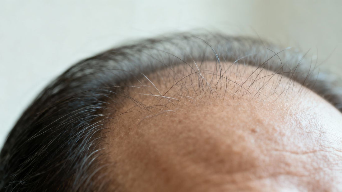Thinning hair on a person's scalp.