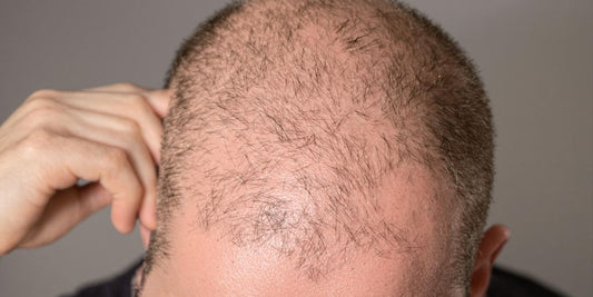 Man's hand holding hair, scalp visible.