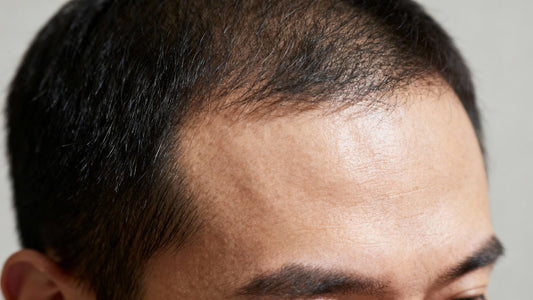Man's head showing hair regrowth timeline