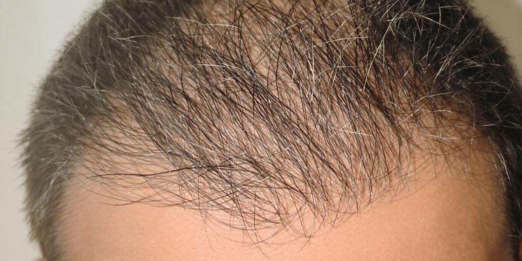 Man experiencing hair thinning near temples