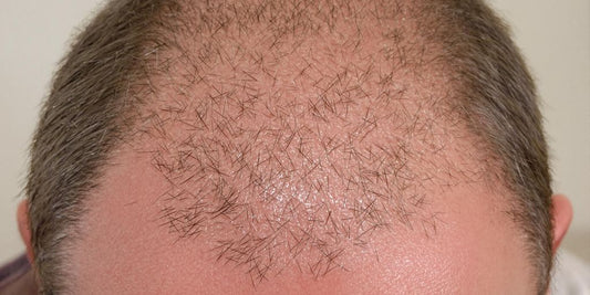 Person's head with noticeably thin hair, looking concerned.