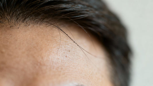Hair shedding on scalp, minoxidil treatment